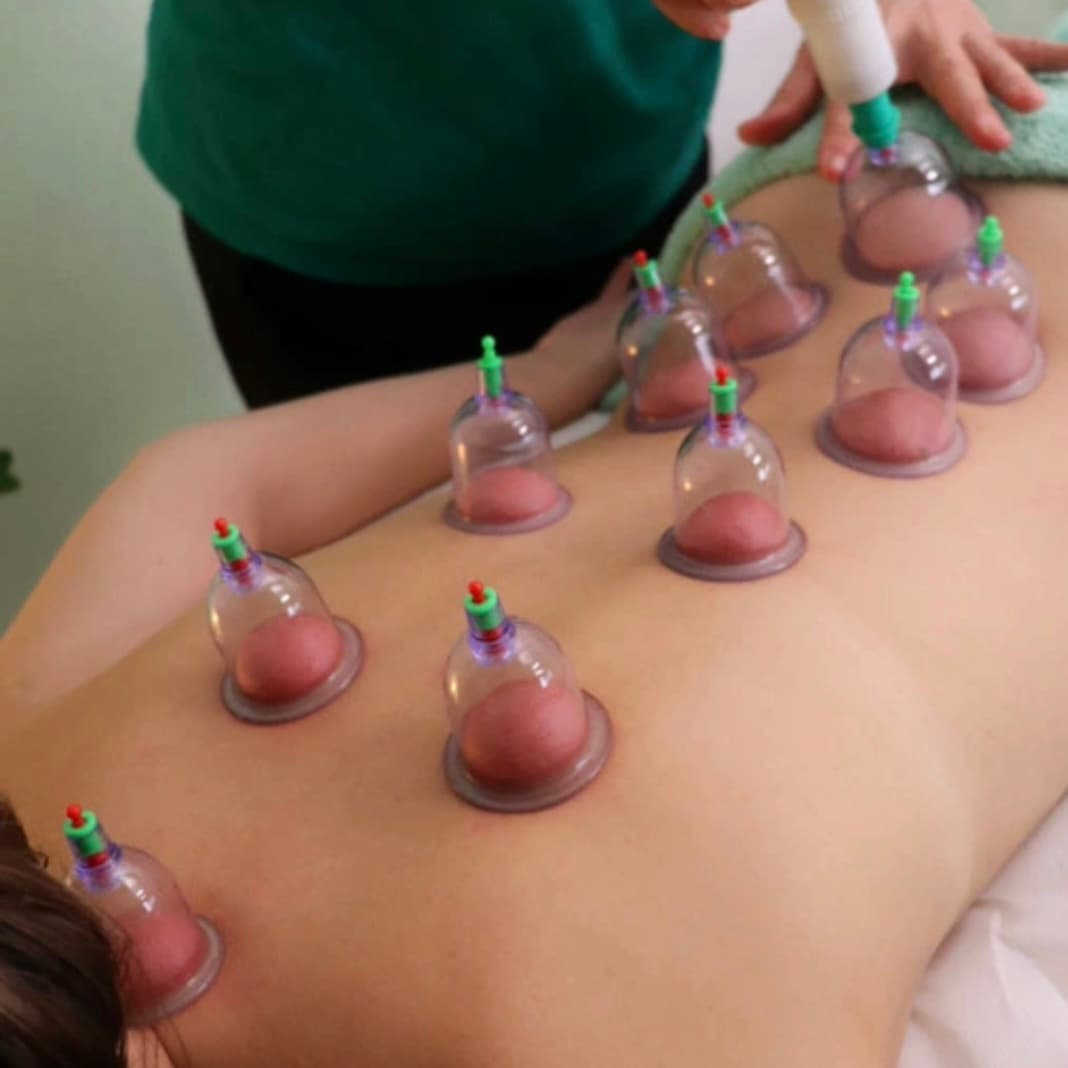 Masaža + Cupping
